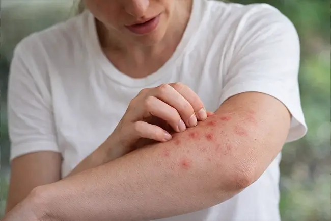 Vrouw krabt jeukende huiduitslag op haar arm veroorzaakt door verhoogde cortisol en histamine